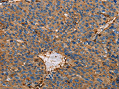 The image on the left is immunohistochemistry of paraffin-embedded Human liver cancer tissue using the antibody Antibody) at dilution 1/65, on the right is treated with fusion protein. (Original magnification: ×200)