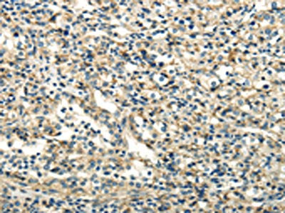 The image on the left is immunohistochemistry of paraffin-embedded Human prostate cancer tissue using DLAT Antibody(DLAT Antibody) at dilution 1/40, on the right is treated with fusion protein. (Original magnification: ×200)Rabbit anti-Human DLAT Polyclonal Antibody