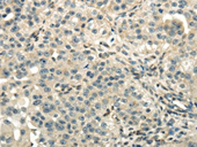 The image on the left is immunohistochemistry of paraffin-embedded Human breast cancer tissue using the antibody Antibody) at dilution 1/40, on the right is treated with fusion protein. (Original magnification: ×200)Rabbit anti-Human DLAT Polyclonal Antibody