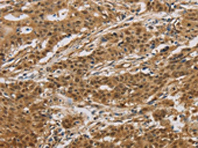 The image on the left is immunohistochemistry of paraffin-embedded Human gastric cancer tissue using HSPA4 Antibody(HSPA4 Antibody) at dilution 1/20, on the right is treated with fusion protein. (Original magnification: ×200)Rabbit anti-Human HSPA4 Polyclonal Antibody