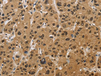 The image on the left is immunohistochemistry of paraffin-embedded Human liver cancer tissue using the antibody Antibody) at dilution 1/20, on the right is treated with fusion protein. (Original magnification: ×200)Rabbit anti-Human HSPA4 Polyclonal Antibody