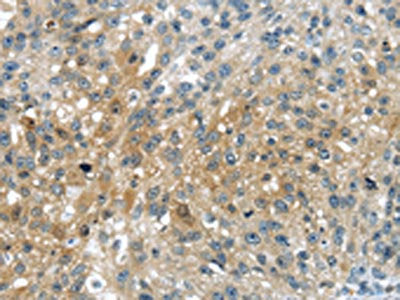 The image on the left is immunohistochemistry of paraffin-embedded Human breast cancer tissue using UPP2 Antibody(UPP2 Antibody) at dilution 1/35, on the right is treated with synthetic peptide. (Original magnification: ×200)Rabbit anti-Human UPP2 Polyclonal Antibody