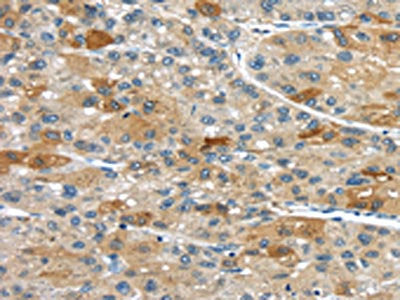 The image on the left is immunohistochemistry of paraffin-embedded Human liver cancer tissue using the antibody Antibody) at dilution 1/35, on the right is treated with synthetic peptide. (Original magnification: ×200)Rabbit anti-Human UPP2 Polyclonal Antibody