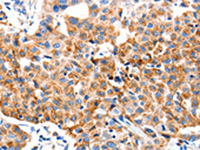 The image on the left is immunohistochemistry of paraffin-embedded Human lung cancer tissue using KLK2 Antibody(KLK2 Antibody) at dilution 1/80, on the right is treated with synthetic peptide. (Original magnification: ×200)