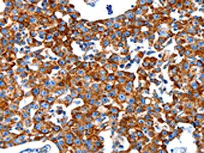 The image on the left is immunohistochemistry of paraffin-embedded Human breast cancer tissue using the antibody Antibody) at dilution 1/80, on the right is treated with synthetic peptide. (Original magnification: ×200)