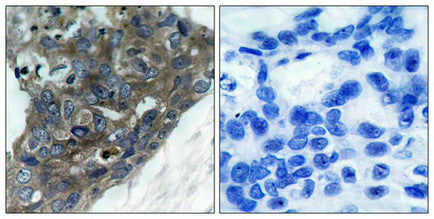 Immunohistochemical analysis of paraffin-embedded human breast carcinoma tissue using ASK1(Ab-966) Antibody(left) or the same antibody preincubated with blocking peptide(right).