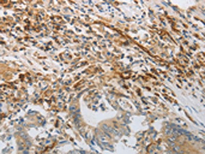 The image on the left is immunohistochemistry of paraffin-embedded Human colon cancer tissue using PECAM1 Antibody(PECAM1 Antibody) at dilution 1/30, on the right is treated with synthetic peptide. (Original magnification: ×200)Rabbit anti-Human PECAM1 Polyclonal Antibody