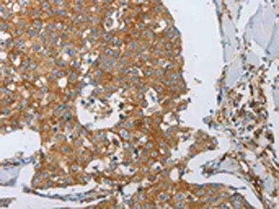 The image on the left is immunohistochemistry of paraffin-embedded Human breast cancer tissue using the antibody Antibody) at dilution 1/30, on the right is treated with synthetic peptide. (Original magnification: ×200)Rabbit anti-Human PECAM1 Polyclonal Antibody