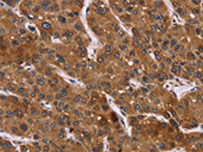 The image on the left is immunohistochemistry of paraffin-embedded Human liver cancer tissue using PPIB Antibody(PPIB Antibody) at dilution 1/45, on the right is treated with fusion protein. (Original magnification: ×200)Rabbit anti-Human PPIB Polyclonal Antibody
