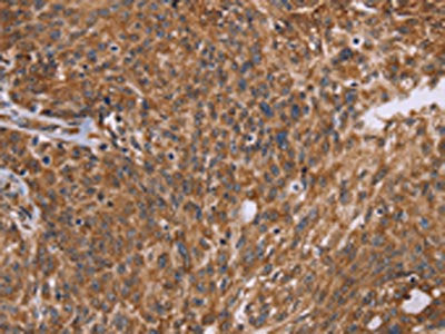 The image on the left is immunohistochemistry of paraffin-embedded Human ovarian cancer tissue using the antibody Antibody) at dilution 1/45, on the right is treated with fusion protein. (Original magnification: ×200)Rabbit anti-Human PPIB Polyclonal Antibody