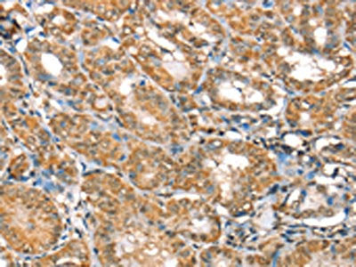The image on the left is immunohistochemistry of paraffin-embedded Human thyroid cancer tissue using RBM5 Antibody(RBM5 Antibody) at dilution 1/30, on the right is treated with fusion protein. (Original magnification: ×200)Rabbit anti-Human RBM5 Polyclonal Antibody