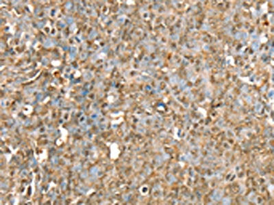 The image on the left is immunohistochemistry of paraffin-embedded Human ovarian cancer tissue using the antibody Antibody) at dilution 1/30, on the right is treated with fusion protein. (Original magnification: ×200)Rabbit anti-Human RBM5 Polyclonal Antibody