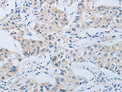The image on the left is immunohistochemistry of paraffin-embedded Human lung cancer tissue using MME Antibody(MME Antibody) at dilution 1/45, on the right is treated with synthetic peptide. (Original magnification: ×200)Rabbit anti-Human MME Polyclonal Antibody