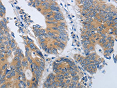 The image on the left is immunohistochemistry of paraffin-embedded Human colon cancer tissue using the antibody Antibody) at dilution 1/45, on the right is treated with synthetic peptide. (Original magnification: ×200)