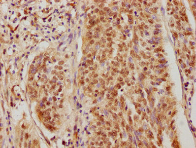 IHC image of CSNK2A3 Antibody diluted at 1:400 and staining in paraffin-embedded human cervical cancer performed on a Leica BondTM system. After dewaxing and hydration, antigen retrieval was mediated by high pressure in a citrate buffer (pH 6.0). Section was blocked with 10% normal goat serum 30min at RT. Then primary antibody (1% BSA) was incubated at 4°C overnight. The primary is detected by a biotinylated secondary antibody and visualized using an HRP conjugated SP system.Rabbit anti-Human CSNK2A3 Polyclonal Antibody