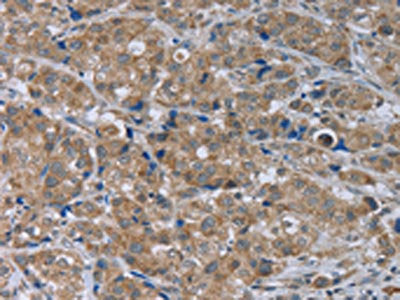 The image on the left is immunohistochemistry of paraffin-embedded Human breast cancer tissue using GABRB1 Antibody(GABRB1 Antibody) at dilution 1/50, on the right is treated with fusion protein. (Original magnification: ×200)Rabbit anti-Human GABRB1 Polyclonal Antibody