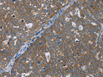 The image on the left is immunohistochemistry of paraffin-embedded Human ovarian cancer tissue using the antibody Antibody) at dilution 1/50, on the right is treated with fusion protein. (Original magnification: ×200)Rabbit anti-Human GABRB1 Polyclonal Antibody