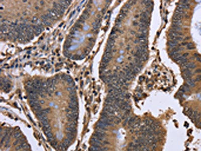 The image on the left is immunohistochemistry of paraffin-embedded Human colon cancer tissue using DCP1A Antibody(DCP1A Antibody) at dilution 1/50, on the right is treated with fusion protein. (Original magnification: ×200)Rabbit anti-Human DCP1A Polyclonal Antibody