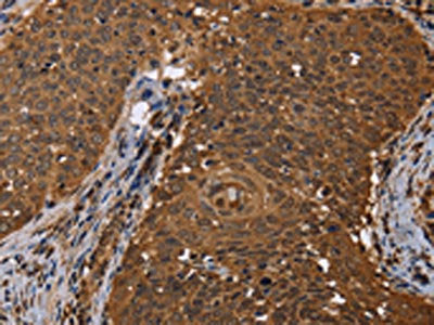 The image on the left is immunohistochemistry of paraffin-embedded Human cervical cancer tissue using the antibody Antibody) at dilution 1/50, on the right is treated with fusion protein. (Original magnification: ×200)Rabbit anti-Human DCP1A Polyclonal Antibody