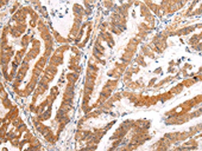 The image on the left is immunohistochemistry of paraffin-embedded Human esophagus cancer tissue using AP2A1 Antibody(AP2A1 Antibody) at dilution 1/20, on the right is treated with synthetic peptide. (Original magnification: ×200)Rabbit anti-Human AP2A1 Polyclonal Antibody