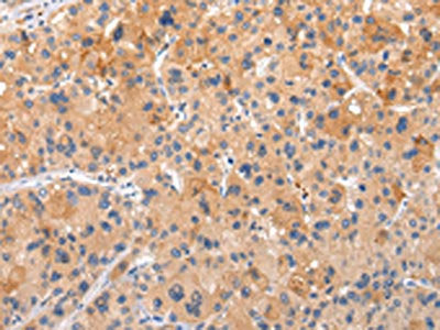 The image on the left is immunohistochemistry of paraffin-embedded Human liver cancer tissue using the antibody Antibody) at dilution 1/20, on the right is treated with synthetic peptide. (Original magnification: ×200)Rabbit anti-Human AP2A1 Polyclonal Antibody
