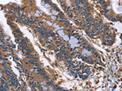 The image on the left is immunohistochemistry of paraffin-embedded Human colon cancer tissue using ILK Antibody(ILK Antibody) at dilution 1/50, on the right is treated with fusion protein. (Original magnification: ×200)Rabbit anti-Human ILK Polyclonal Antibody