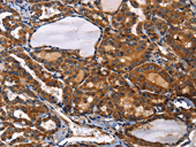 The image on the left is immunohistochemistry of paraffin-embedded Human thyroid cancer tissue using the antibody Antibody) at dilution 1/50, on the right is treated with fusion protein. (Original magnification: ×200)Rabbit anti-Human ILK Polyclonal Antibody