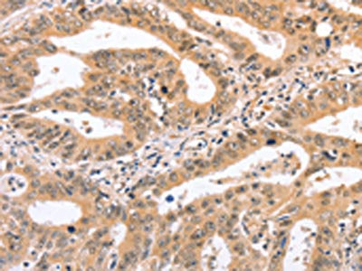 The image on the left is immunohistochemistry of paraffin-embedded Human gastric cancer tissue using NCAM1 Antibody(NCAM1 Antibody) at dilution 1/50, on the right is treated with synthetic peptide. (Original magnification: ×200)Rabbit anti-Human NCAM1 Polyclonal Antibody