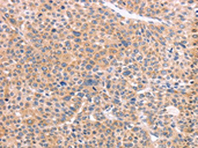 The image on the left is immunohistochemistry of paraffin-embedded Human liver cancer tissue using the antibody Antibody) at dilution 1/50, on the right is treated with synthetic peptide. (Original magnification: ×200)Rabbit anti-Human NCAM1 Polyclonal Antibody