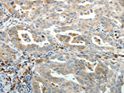 The image on the left is immunohistochemistry of paraffin-embedded Human ovarian cancer tissue using PTEN Antibody(PTEN Antibody) at dilution 1/20, on the right is treated with synthetic peptide. (Original magnification: ×200)Rabbit anti-Human PTEN Polyclonal Antibody