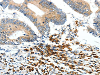 The image on the left is immunohistochemistry of paraffin-embedded Human colon cancer tissue using the antibody Antibody) at dilution 1/20, on the right is treated with synthetic peptide. (Original magnification: ×200)Rabbit anti-Human PTEN Polyclonal Antibody