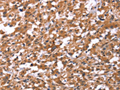 The image on the left is immunohistochemistry of paraffin-embedded Human thyroid cancer tissue using the antibody Antibody) at dilution 1/40, on the right is treated with synthetic peptide. (Original magnification: ×200)Rabbit anti-Human HSD17B1 Polyclonal Antibody