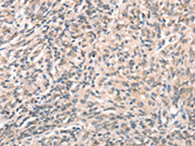 The image on the left is immunohistochemistry of paraffin-embedded Human prostate cancer tissue using DECR1 Antibody(DECR1 Antibody) at dilution 1/50, on the right is treated with synthetic peptide. (Original magnification: ×200)