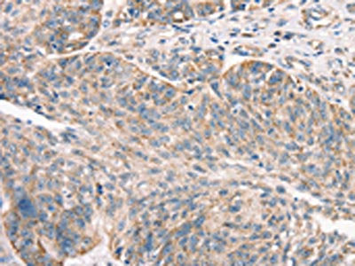 The image on the left is immunohistochemistry of paraffin-embedded Human ovarian cancer tissue using the antibody Antibody) at dilution 1/50, on the right is treated with synthetic peptide. (Original magnification: ×200)