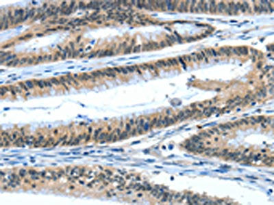 The image on the left is immunohistochemistry of paraffin-embedded Human colon cancer tissue using EIF4EBP1 Antibody(EIF4EBP1 Antibody) at dilution 1/50, on the right is treated with fusion protein. (Original magnification: ×200)Rabbit anti-Human EIF4EBP1 Polyclonal Antibody