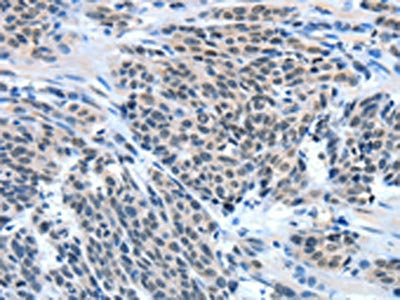 The image on the left is immunohistochemistry of paraffin-embedded Human esophagus cancer tissue using the antibody Antibody) at dilution 1/50, on the right is treated with fusion protein. (Original magnification: ×200)Rabbit anti-Human EIF4EBP1 Polyclonal Antibody