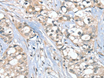 The image on the left is immunohistochemistry of paraffin-embedded Human breast cancer tissue using SGPL1 Antibody(SGPL1 Antibody) at dilution 1/25, on the right is treated with synthetic peptide. (Original magnification: ×200)Rabbit anti-Human SGPL1 Polyclonal Antibody