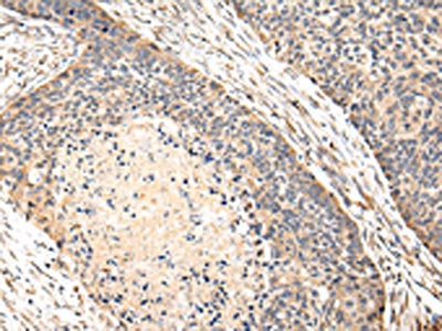 The image on the left is immunohistochemistry of paraffin-embedded Human esophagus cancer tissue using VPS35 Antibody(VPS35 Antibody) at dilution 1/30, on the right is treated with fusion protein. (Original magnification: ×200)Rabbit anti-Human VPS35 Polyclonal Antibody