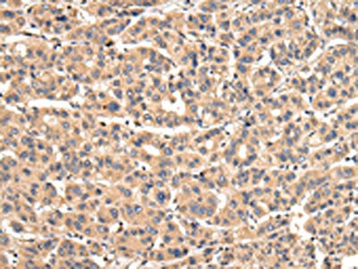 The image on the left is immunohistochemistry of paraffin-embedded Human liver cancer tissue using the antibody Antibody) at dilution 1/30, on the right is treated with fusion protein. (Original magnification: ×200)Rabbit anti-Human VPS35 Polyclonal Antibody