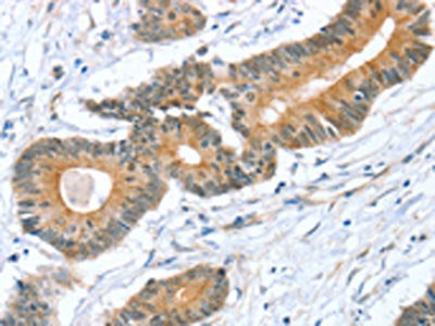 The image on the left is immunohistochemistry of paraffin-embedded Human colon cancer tissue using STXBP1 Antibody(STXBP1 Antibody) at dilution 1/20, on the right is treated with fusion protein. (Original magnification: ×200)Rabbit anti-Human STXBP1 Polyclonal Antibody