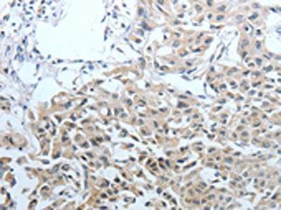 The image on the left is immunohistochemistry of paraffin-embedded Human lung cancer tissue using CEACAM1 Antibody(CEACAM1 Antibody) at dilution 1/25, on the right is treated with fusion protein. (Original magnification: ×200)Rabbit anti-Human CEACAM1 Polyclonal Antibody