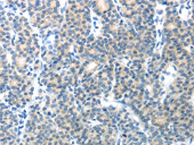 The image on the left is immunohistochemistry of paraffin-embedded Human thyroid cancer tissue using the antibody Antibody) at dilution 1/25, on the right is treated with fusion protein. (Original magnification: ×200)Rabbit anti-Human CEACAM1 Polyclonal Antibody
