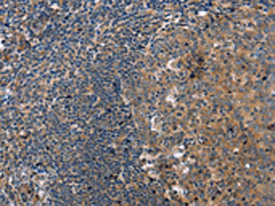 The image on the left is immunohistochemistry of paraffin-embedded Human tonsil tissue using PPP2R3C Antibody(PPP2R3C Antibody) at dilution 1/30, on the right is treated with fusion protein. (Original magnification: ×200)Rabbit anti-Human PPP2R3C Polyclonal Antibody