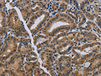 The image on the left is immunohistochemistry of paraffin-embedded Human thyroid cancer tissue using NAT10 Antibody(NAT10 Antibody) at dilution 1/40, on the right is treated with fusion protein. (Original magnification: ×200)Rabbit anti-Human NAT10 Polyclonal Antibody