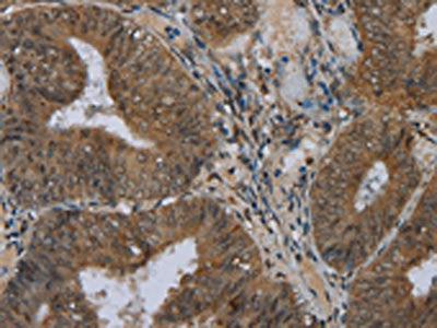 The image on the left is immunohistochemistry of paraffin-embedded Human colon cancer tissue using the antibody Antibody) at dilution 1/40, on the right is treated with fusion protein. (Original magnification: ×200)Rabbit anti-Human NAT10 Polyclonal Antibody