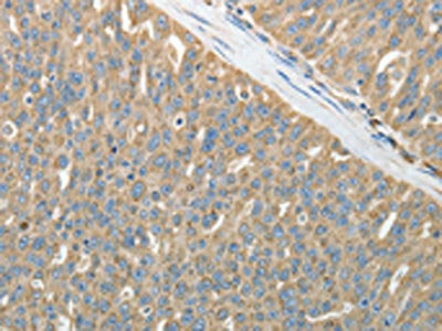 The image on the left is immunohistochemistry of paraffin-embedded Human ovarian cancer tissue using HSP90B1 Antibody(HSP90B1 Antibody) at dilution 1/50, on the right is treated with fusion protein. (Original magnification: ×200)Rabbit anti-Human HSP90B1 Polyclonal Antibody