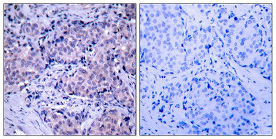 Immunohistochemical analysis of paraffin-embedded human breast carcinoma tissue using PDK1(Ab-241) Antibody(left) or the same antibody preincubated with blocking peptide(right).Rabbit anti-Human PDPK1 Polyclonal Antibody