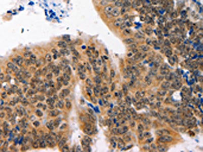 The image on the left is immunohistochemistry of paraffin-embedded Human colon cancer tissue using NAIF1 Antibody(NAIF1 Antibody) at dilution 1/60, on the right is treated with fusion protein. (Original magnification: ×200)Rabbit anti-Human NAIF1 Polyclonal Antibody