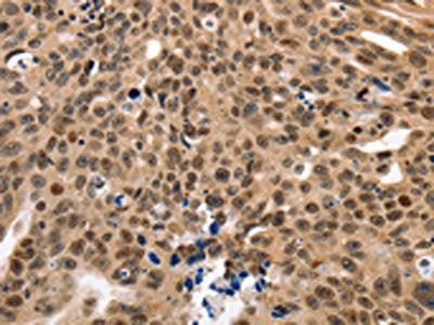 The image on the left is immunohistochemistry of paraffin-embedded Human ovarian cancer tissue using the antibody Antibody) at dilution 1/60, on the right is treated with fusion protein. (Original magnification: ×200)Rabbit anti-Human NAIF1 Polyclonal Antibody