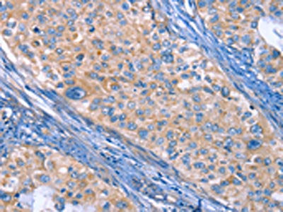 The image on the left is immunohistochemistry of paraffin-embedded Human cervical cancer tissue using ITGB3 Antibody(ITGB3 Antibody) at dilution 1/30, on the right is treated with fusion protein. (Original magnification: ×200)